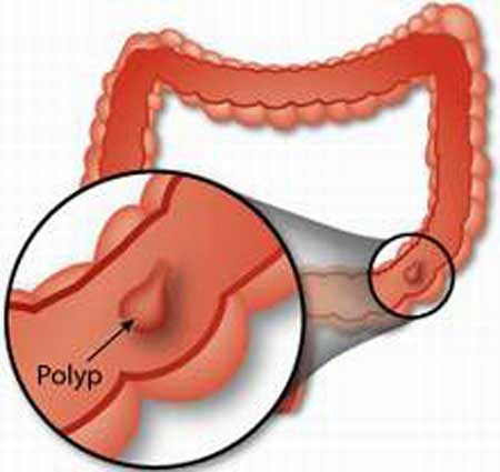 Bệnh Polyp hậu môn là gì?